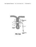 TISSUE FASTENING DEVICES AND PROCESSES THAT PROMOTE TISSUE ADHESION diagram and image