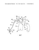 Occluding Catheter and Dynamic Method for Prevention of Stroke diagram and image