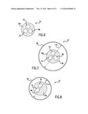 Occluding Catheter and Dynamic Method for Prevention of Stroke diagram and image