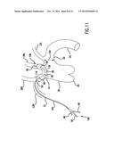 Occluding Catheter and Dynamic Method for Prevention of Stroke diagram and image