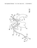 Occluding Catheter and Dynamic Method for Prevention of Stroke diagram and image