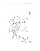 Occluding Catheter and Dynamic Method for Prevention of Stroke diagram and image