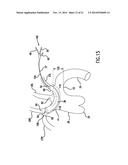 Occluding Catheter and Dynamic Method for Prevention of Stroke diagram and image