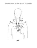 Occluding Catheter and Dynamic Method for Prevention of Stroke diagram and image