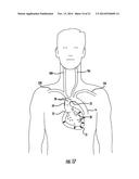 Occluding Catheter and Dynamic Method for Prevention of Stroke diagram and image