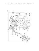 Occluding Catheter and Dynamic Method for Prevention of Stroke diagram and image