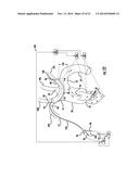 Occluding Catheter and Dynamic Method for Prevention of Stroke diagram and image