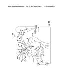 Occluding Catheter and Dynamic Method for Prevention of Stroke diagram and image