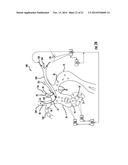 Occluding Catheter and Dynamic Method for Prevention of Stroke diagram and image