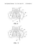 BALLOON CATHETERS AND METHODS FOR TREATING PARANASAL SINUSES diagram and image