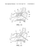 BALLOON CATHETERS AND METHODS FOR TREATING PARANASAL SINUSES diagram and image