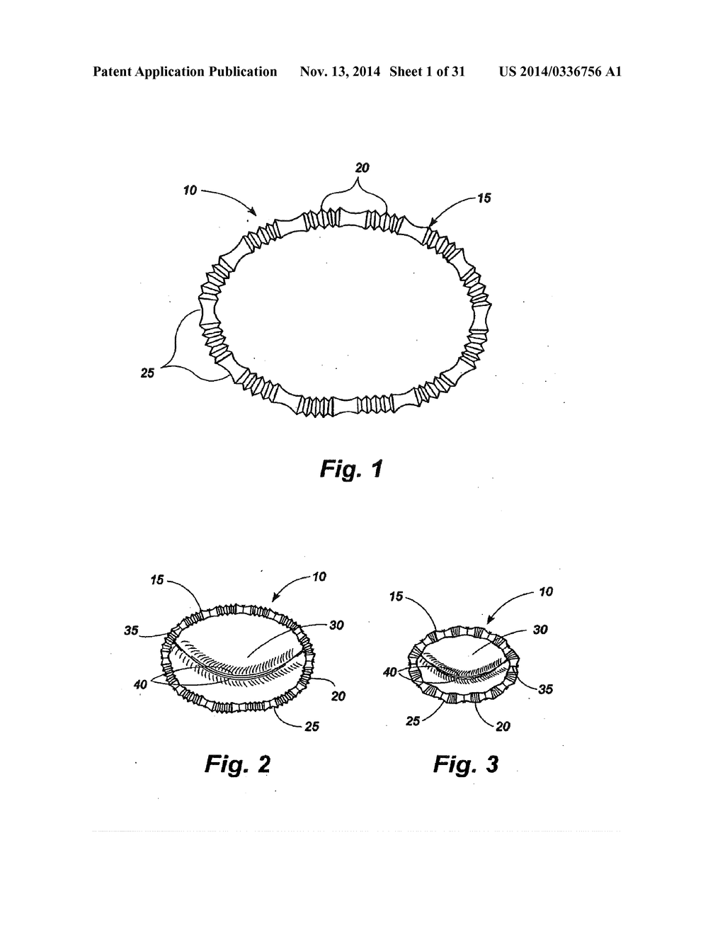 METHODS AND APPARATUS FOR CONTROLLING THE INTERNAL CIRCUMFERENCE OF AN     ANATOMIC ORIFICE OR LUMEN - diagram, schematic, and image 02