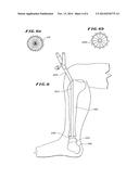 ANKLE REPLACEMENT SYSTEM diagram and image