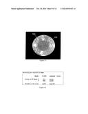 METHOD AND APPARATUS FOR AUTOMATED PLACEMENT OF SCANNED LASER     CAPSULORHEXIS INCISIONS diagram and image