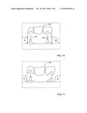 METHOD AND SYSTEM FOR PROVIDING FEEDBACK DATA USEFUL IN PROTHODONTIC     PROCEDURES ASSOCIATED WITH THE INTRA ORAL CAVITY diagram and image