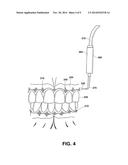 Device and Method for Treating Oral Pigmentation diagram and image