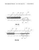 LOCAL DELIVERY OF WATER-SOLUBLE OR WATER-INSOLUBLE THERAPEUTIC AGENTS TO     THE SURFACE OF BODY LUMENS diagram and image