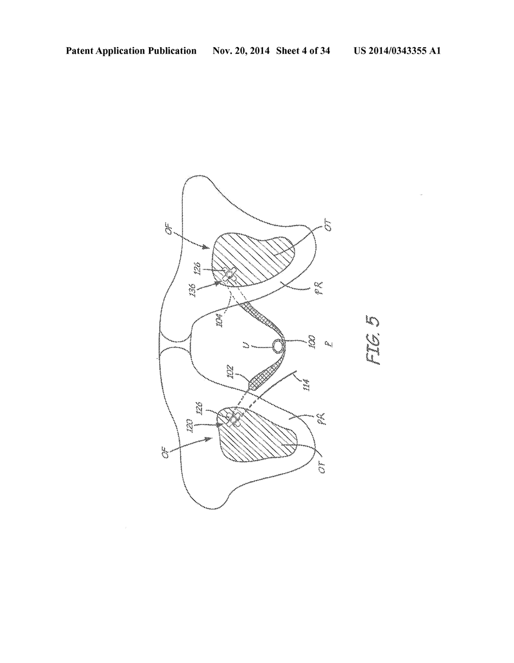 SACROCOLPOPEXY SUPPORT - diagram, schematic, and image 05