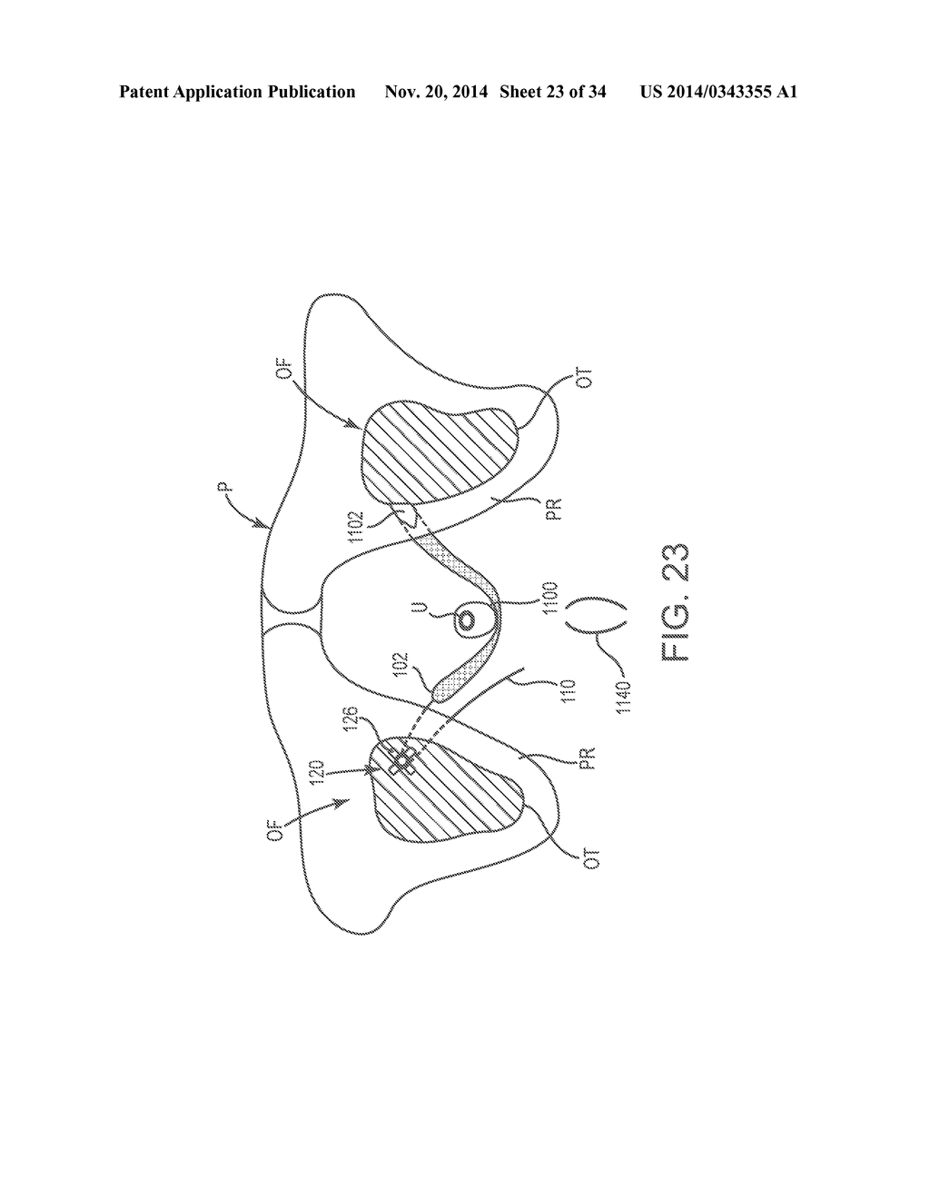 SACROCOLPOPEXY SUPPORT - diagram, schematic, and image 24