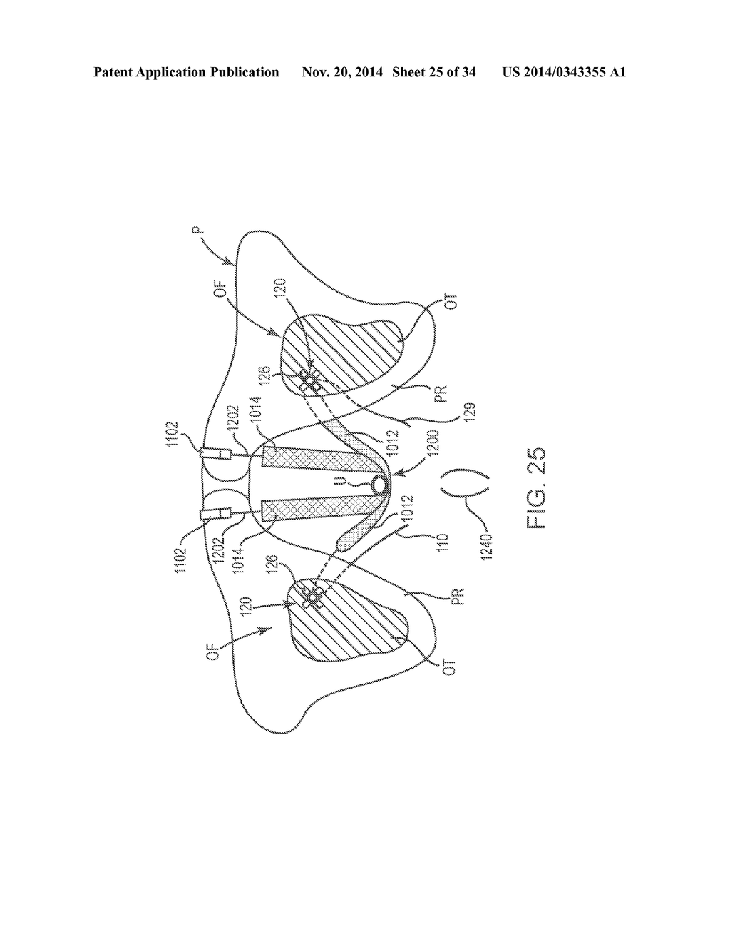 SACROCOLPOPEXY SUPPORT - diagram, schematic, and image 26