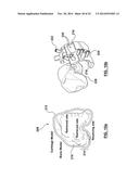 Patient-Specific Surgical Guidance Tool and Method of Use diagram and image