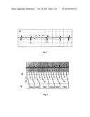 System and Computer Program Product for Automatically Distinguishing     Atrial Flutter from Atrial Fibrillation diagram and image