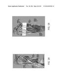 Methods, Systems, and Devices for Treating Neuromas, Fibromas, Nerve     Entrapment, and/or Pain Associated Therewith diagram and image