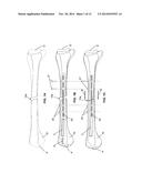 ENDOSTEAL NAIL PLATE FOR FIXING BONE SEGMENTS diagram and image