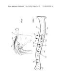 ENDOSTEAL NAIL PLATE FOR FIXING BONE SEGMENTS diagram and image