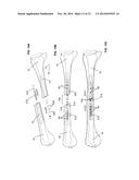 ENDOSTEAL NAIL PLATE FOR FIXING BONE SEGMENTS diagram and image