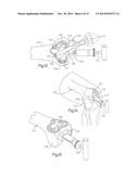 METHOD OF PREPARING A FEMUR AND TIBIA IN KNEE ARTHROPLASTY diagram and image