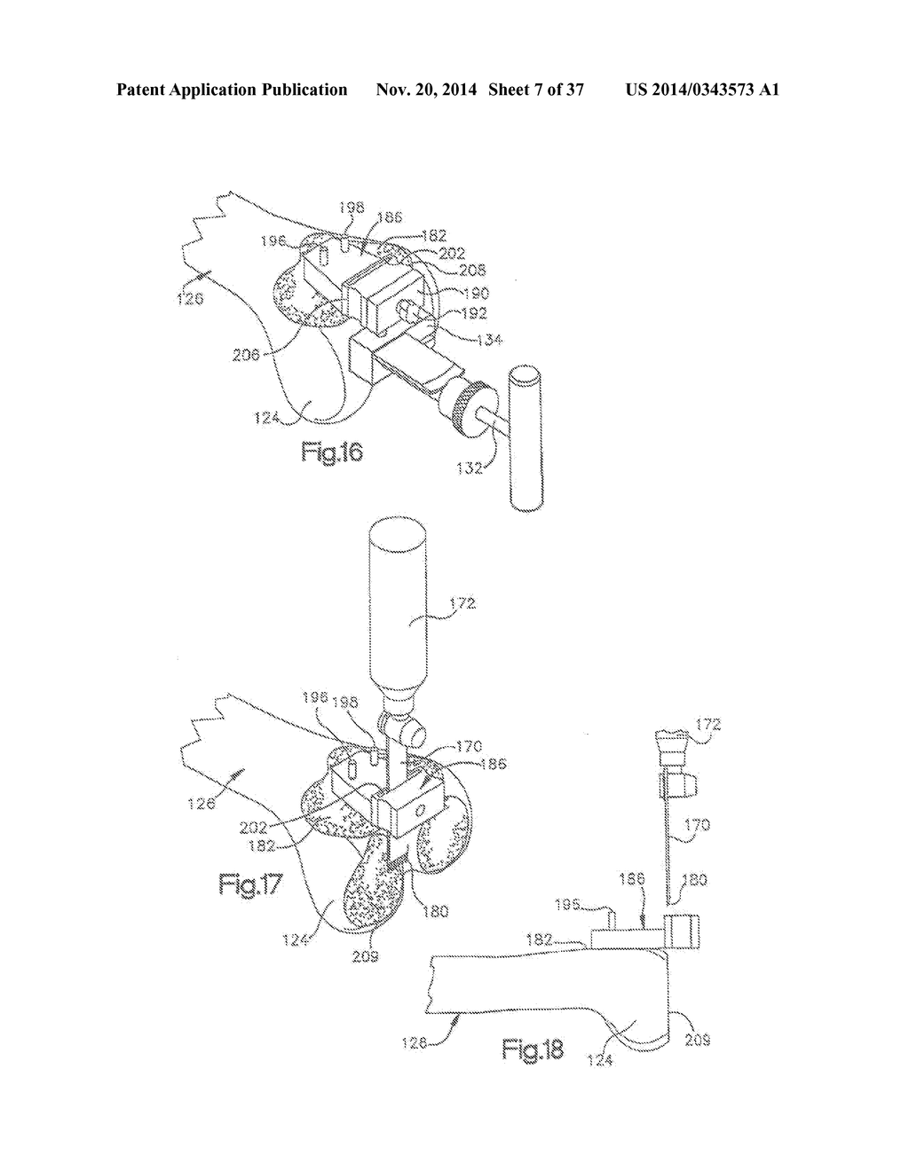 METHOD OF PREPARING A FEMUR AND TIBIA IN KNEE ARTHROPLASTY - diagram, schematic, and image 08