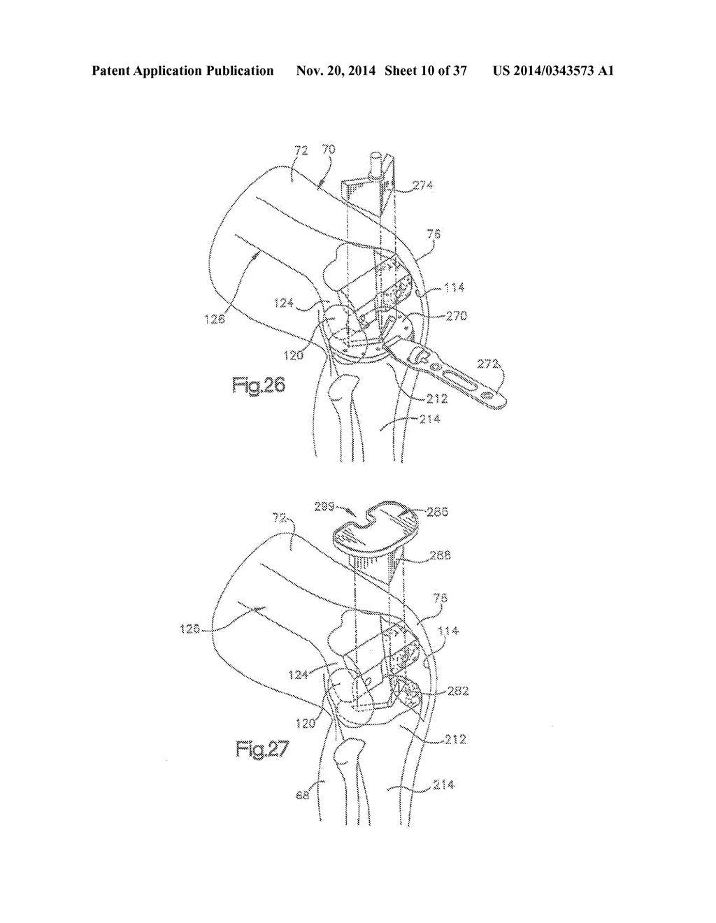 METHOD OF PREPARING A FEMUR AND TIBIA IN KNEE ARTHROPLASTY - diagram, schematic, and image 11