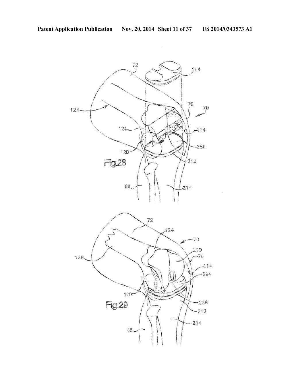 METHOD OF PREPARING A FEMUR AND TIBIA IN KNEE ARTHROPLASTY - diagram, schematic, and image 12