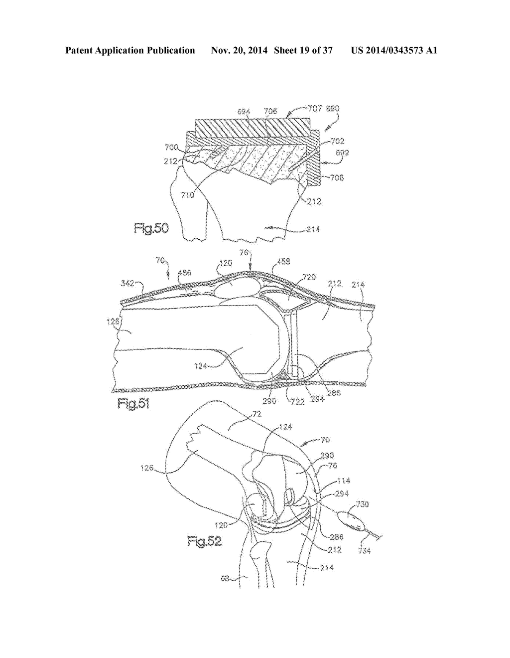 METHOD OF PREPARING A FEMUR AND TIBIA IN KNEE ARTHROPLASTY - diagram, schematic, and image 20