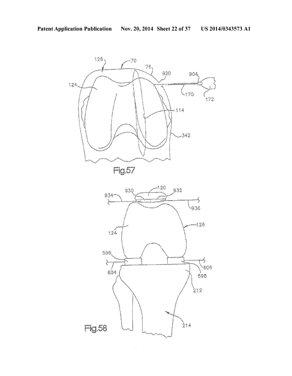 METHOD OF PREPARING A FEMUR AND TIBIA IN KNEE ARTHROPLASTY - diagram, schematic, and image 23