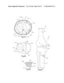 METHOD OF PREPARING A FEMUR AND TIBIA IN KNEE ARTHROPLASTY diagram and image