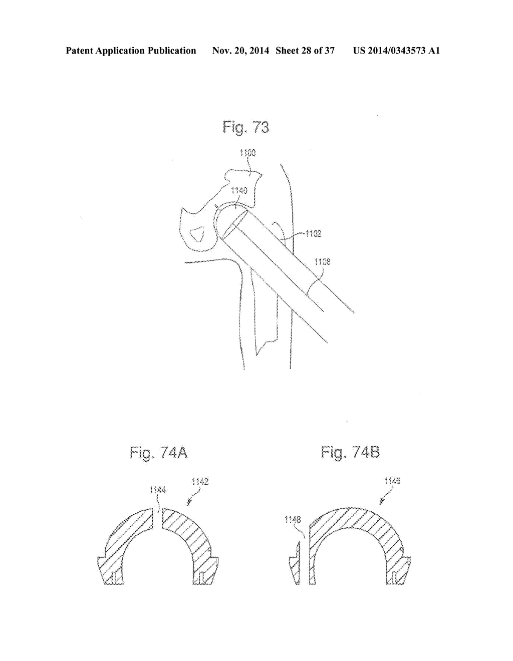 METHOD OF PREPARING A FEMUR AND TIBIA IN KNEE ARTHROPLASTY - diagram, schematic, and image 29