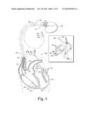 METHOD TO ENHANCE ELECTRODE LOCALIZATION OF A LEAD diagram and image