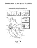 METHOD TO ENHANCE ELECTRODE LOCALIZATION OF A LEAD diagram and image