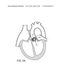 PROSTHETIC HEART VALVE DELIVERY APPARATUS diagram and image