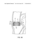 PROSTHETIC HEART VALVE DELIVERY APPARATUS diagram and image