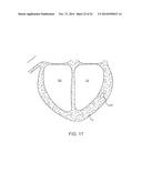 Delivery Of Biological Compounds To Ischemic And/Or Infarcted Tissue diagram and image