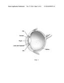 CONTACTLESS PHOTODISRUPTIVE LASER CATARACT SURGERY diagram and image