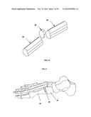 BONE IMPLANTS AND CUTTING APPARATUSES AND METHODS diagram and image