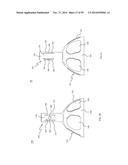 BONE IMPLANTS AND CUTTING APPARATUSES AND METHODS diagram and image