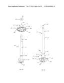 BONE IMPLANTS AND CUTTING APPARATUSES AND METHODS diagram and image