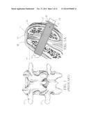 Bioactive Fusion Device diagram and image