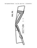 INCREMENTAL AND/OR SUCCESSIVE ADJUSTABLE MANDIBULAR ADVANCEMENT DEVICE FOR     PREVENTING AND TREATMENT OF SNORING AND OBSTRUCTIVE SLEEP APNEA diagram and image