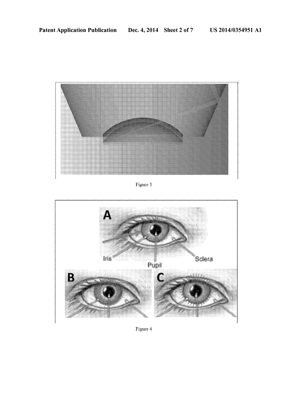 SYSTEMS AND METHODS FOR OBTAINING LOW-ANGLE CIRCUMFERENTIAL OPTICAL ACCESS     TO THE EYE - diagram, schematic, and image 03